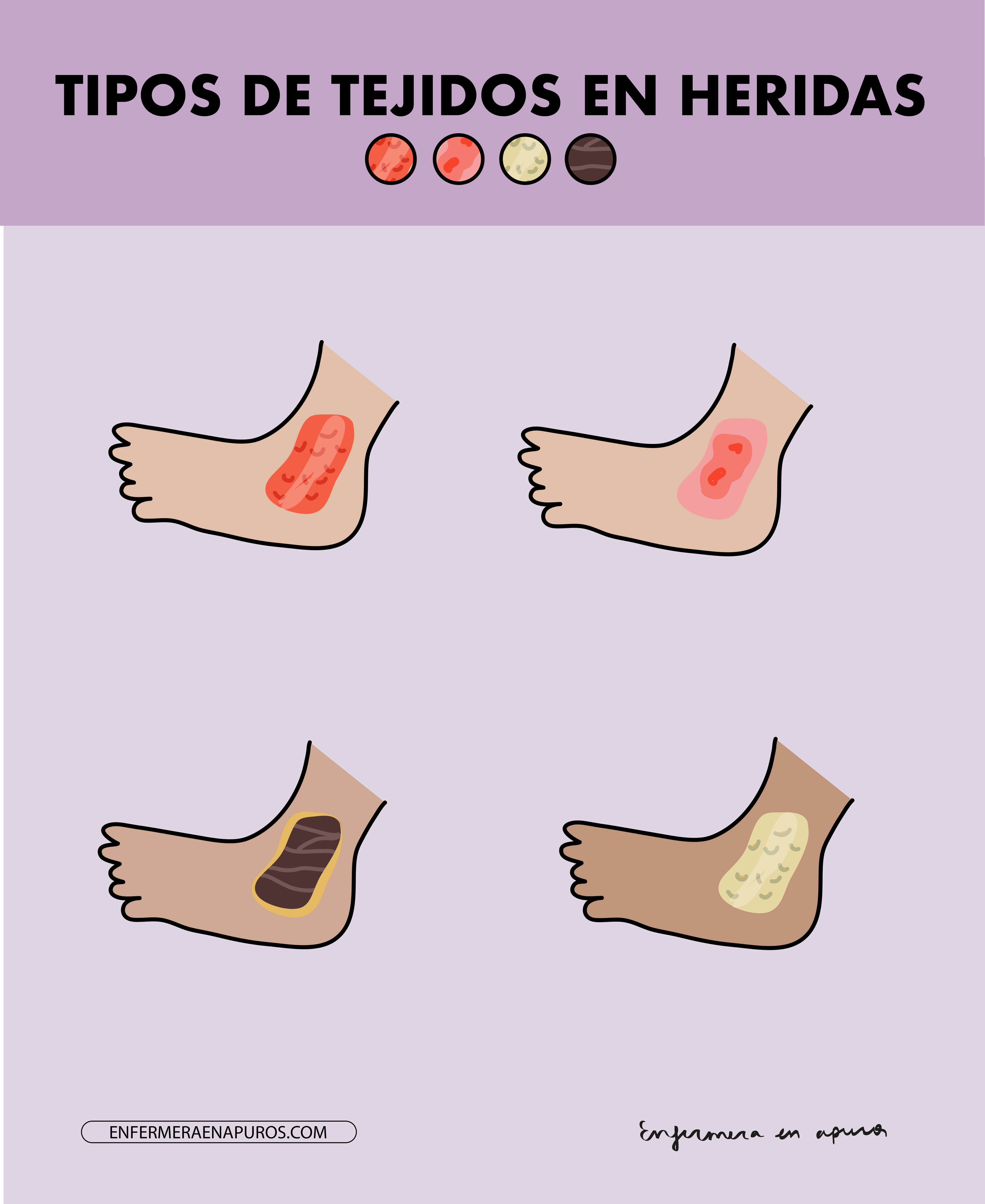 Tipos de tejidos en heridas