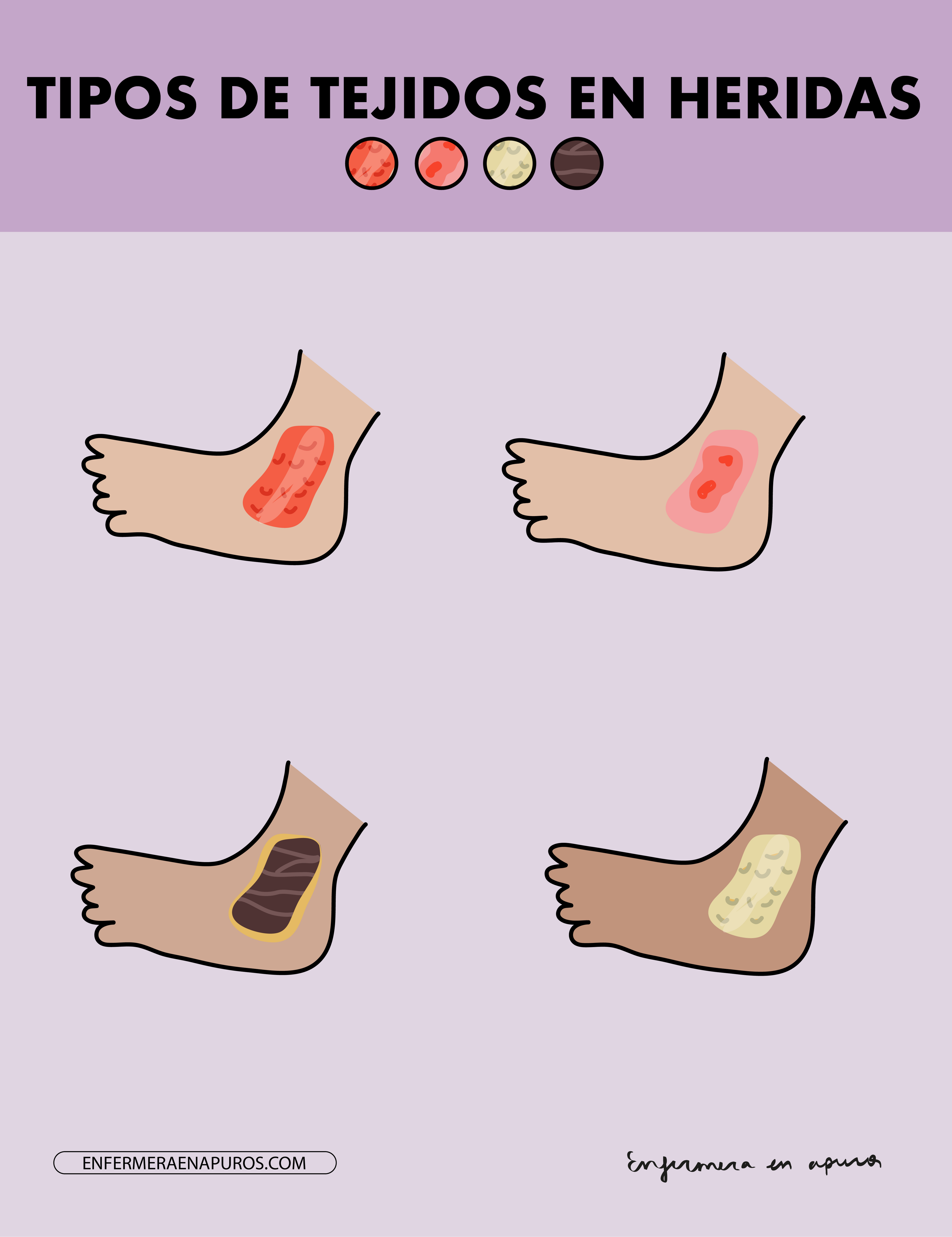 Tipos de tejidos en heridas